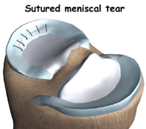 Structured Meniscal tear