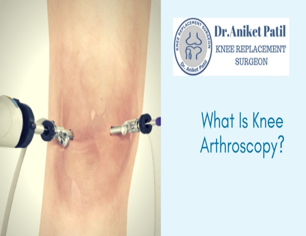 what-is-knee-arthroscopy-dr-aniket-patil