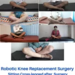 robotic-knee-replacement-surgery-patients-dr-aniket-patil-pune-before-after