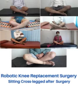 robotic-knee-replacement-surgery-patients-dr-aniket-patil-pune-before-after