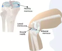 Meniscus Tear Treatment in Pune