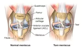 Meniscus Tear Treatment in Pune | Knee Pain Treatment In Pune
