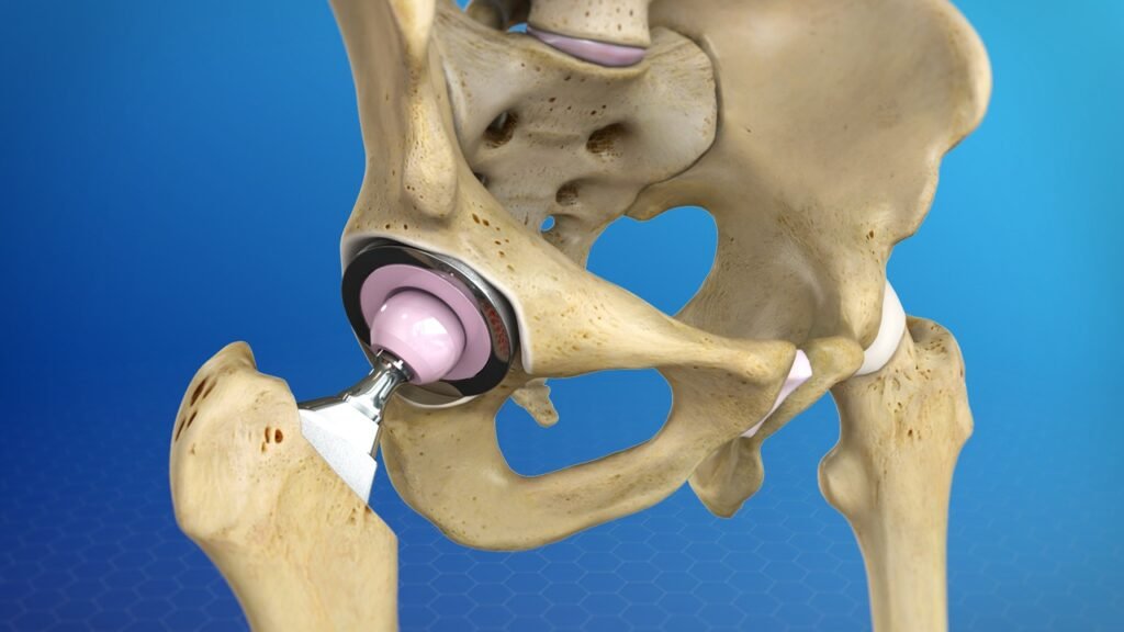A highly detailed metal hip implant showcased prominently in the foreground, designed with intricate architectural components such as screws, stems, and a multi-layered structure, reflecting its robust and durable composition. In the middle ground, softly blurred medical tools and a clinical setting hint at a surgical environment. The background features an abstract representation of a human hip joint, illustrating the typical placement of the implant within the body. The lighting is bright and clinical, emphasizing the gleaming metallic surfaces of the implant, while a slight shadow creates depth. The atmosphere is professional and educational, suitable for a medical discourse. Incorporate the brand name "Dr Aniket Patil" subtly in the lower corner, ensuring no text overlays or distractions.