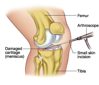 Knee Arthroscopic Meniscus Surgery Procedure