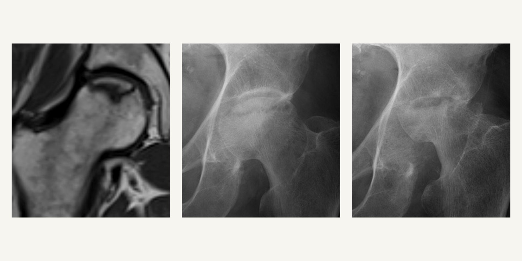 MRI and X-ray images showing avascular necrosis of the femoral head at different stages