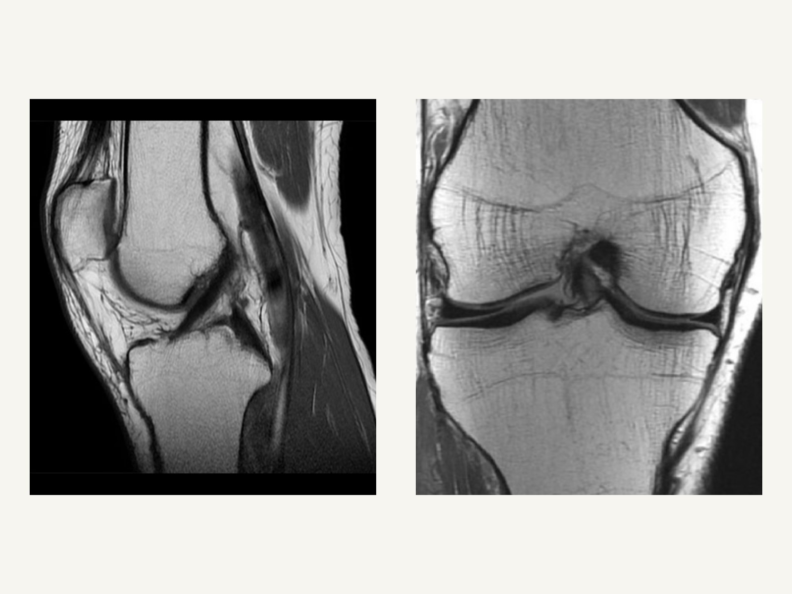 Knee MRI showing ligament and meniscus structures
