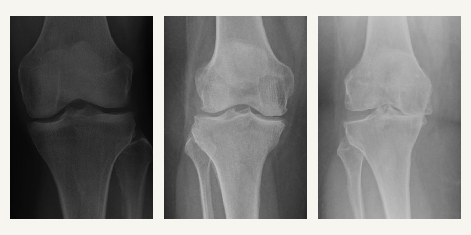 Three illustrative knee radiograph-style panels from left to right showing relatively preserved joint space, clearer joint-space narrowing, and extensive structural change