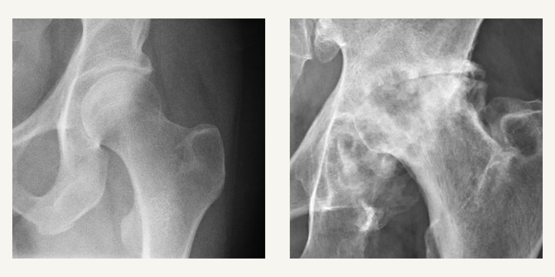 Hip X-rays showing increasing osteoarthritis