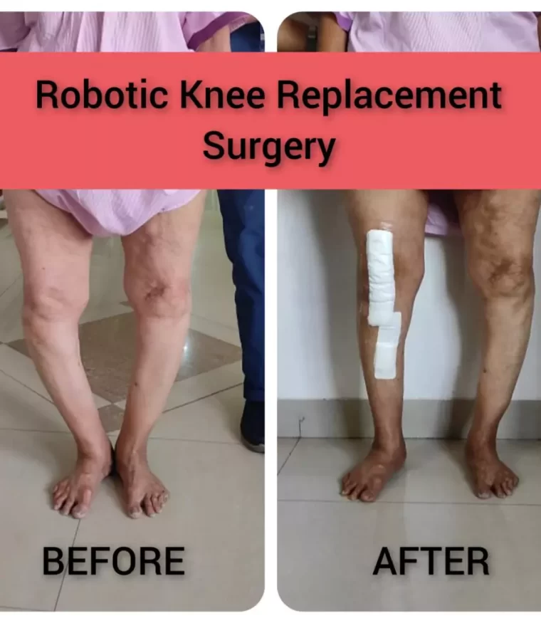 robotic-knee-replacement-surgery-patients-dr-aniket-patil-om-hip-and-knee-speciality-orthopedic-and-physiotherapy-clinic-pune-pcmc-1024×1024 robotic-knee-replacement-surgery-patients-dr-aniket-patil-om-hip-and-knee-speciality-orthopedic-and-physiotherapy-clinic-pune-pcmc